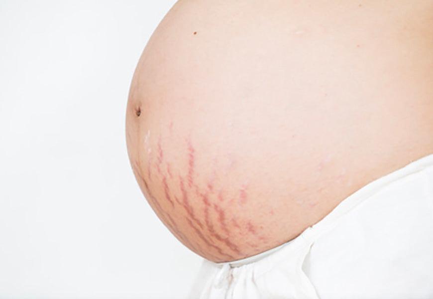 Début de grossesse : comment les vergetures apparaissent ? - Mummy Nantes